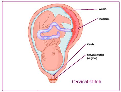 stretching of the vaginal cirvix insertion semen cum in