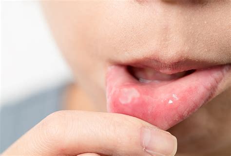 What Causes Canker Sores On Bottom Lip