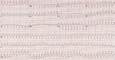 Atrial Flutter With 1 1 Conduction Ecg