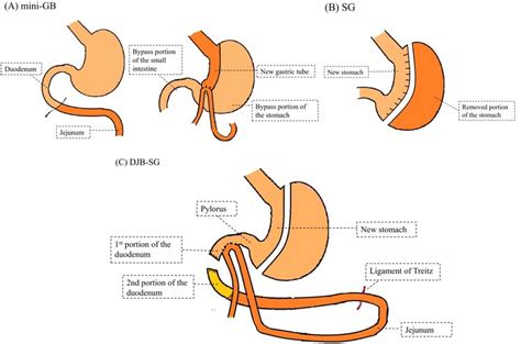 Different Types Of Bariatric Surgery A Mini Gastric