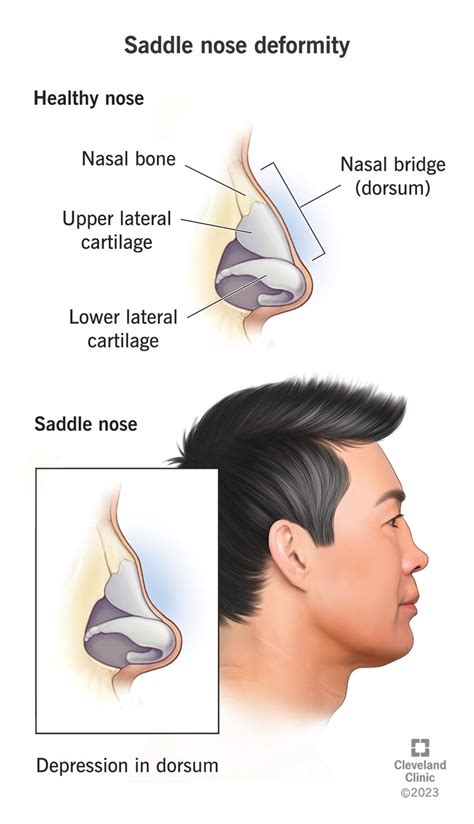saddle nose deformity