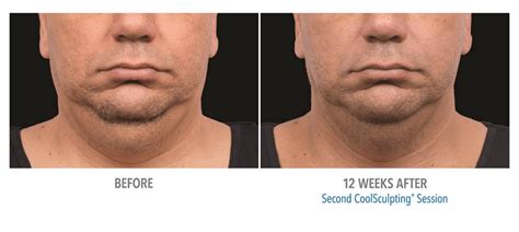 coolsculpting double chin    zcosmetic health