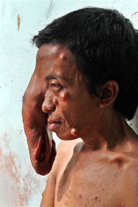 man with tumour that hangs from his face like a trunk and engulfs his eye pleads for help