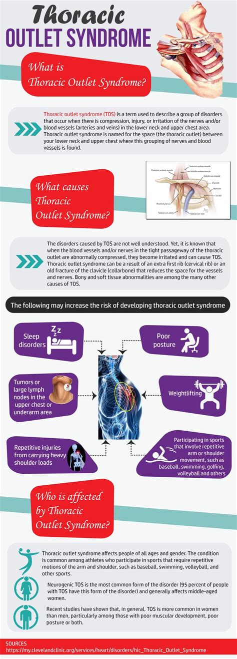 What Is Thoracic Outlet Syndrome — Richmond Rehab