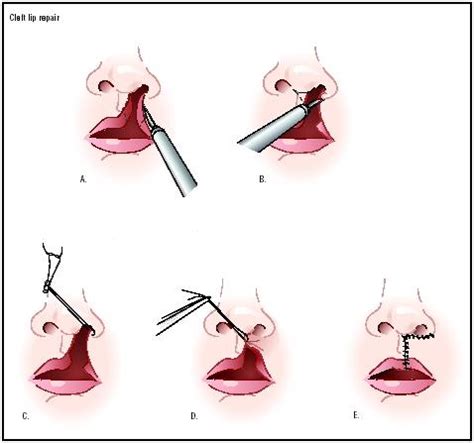 cleft lip repair procedure recovery blood tube time operation