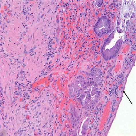 gallbladder sample showing acute  chronic inflam mation  arrow  scientific