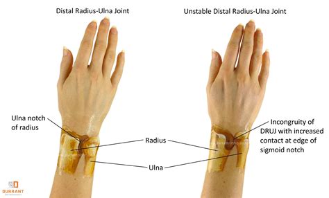 druj instability  wrist distal radial ulnar joint dislocation crpodt