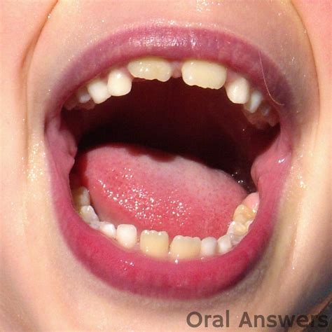differences  baby teeth  permanent teeth oral answers