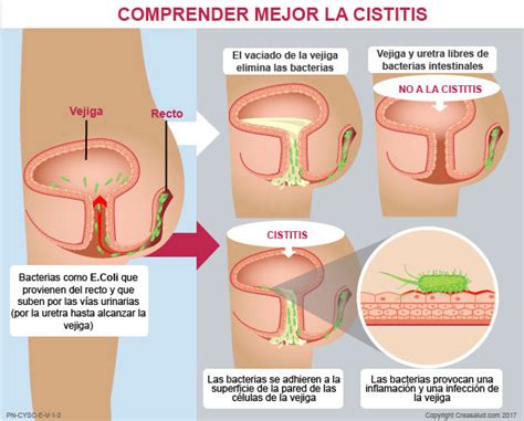 cistitis causas síntomas and tratamientos