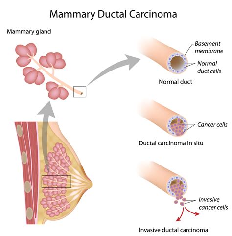 does radiation therapy improve survival for women with ductal carcinoma