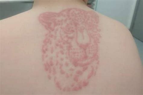 Brothers Suffer Serious Chemical Burns From Black Henna Tattoos On
