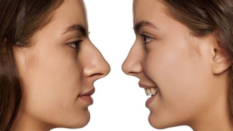faster recovery   nose job costhetics