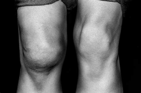 common   swelling   knee