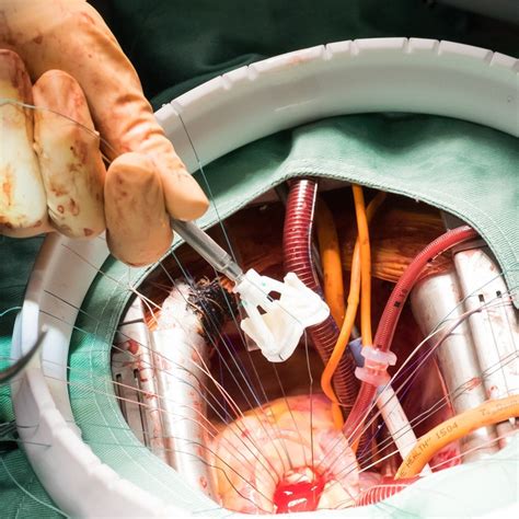 Heart Valve Replacement Surgery Cost In India Health