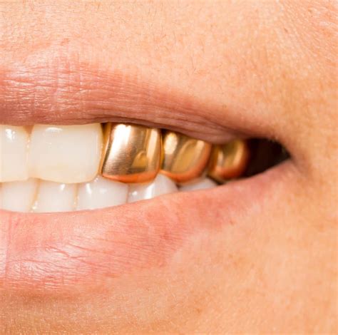 permanent gold teeth cost price chart
