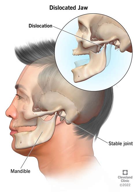 dislocated jaw symptoms  treatment