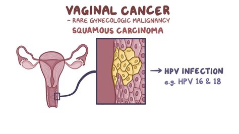 clinical reasoning vaginal cancer osmosis