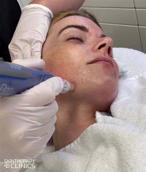 microneedling behandeling skin therapy clinics