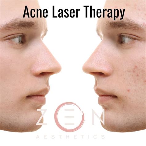med spa  skin boutique   acne laser laser therapy aesthetic