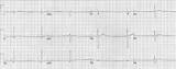 Bradycardia Ecg Sinus Litfl sketch template