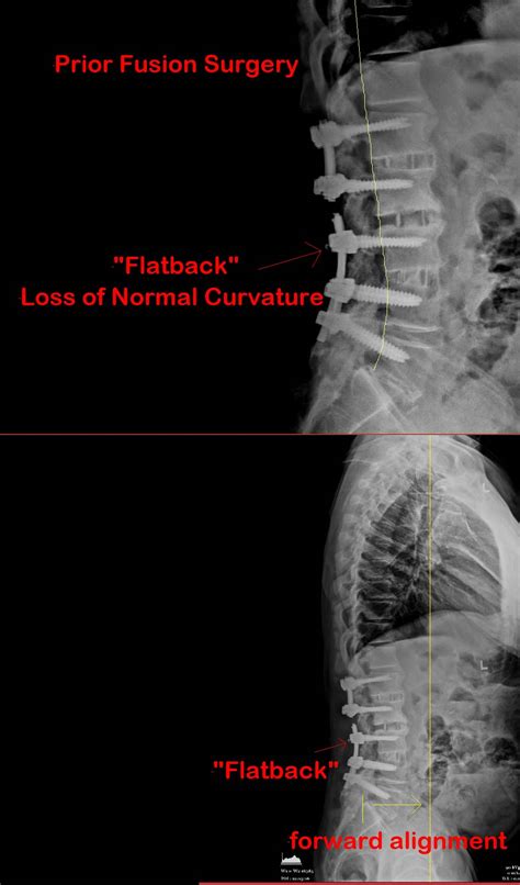 flatback syndrome manhattan spine consultants