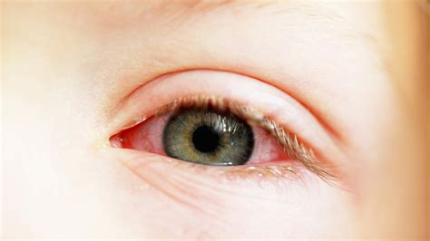 Pink Eye Symtoms Diagnosis Treatment Health