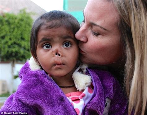 abandoned 3 year old from india with no nose adopted by ohio woman
