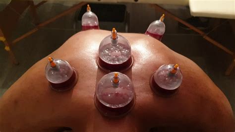 alhijama alshifa wet cupping therapy 1 youtube