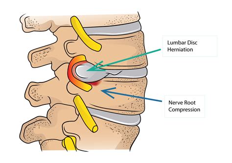 lumbar disc herniation  sciatica dr yu chao lee