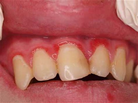 dental aspect  nijmegen breakage syndrome nowa stomatologia   czytelnia medyczna borgis