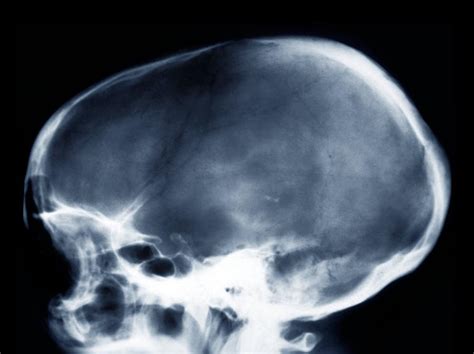 dolichocephalic skull deformity buyxraysonline