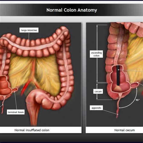 Normal Colon Anatomy Trialexhibits Inc