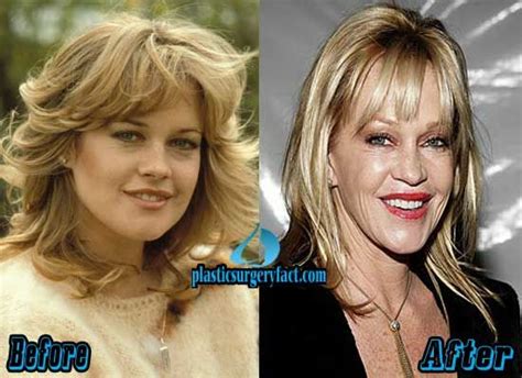 pin by lucia manymore on celebrity before and after pinterest plastic surgery melanie