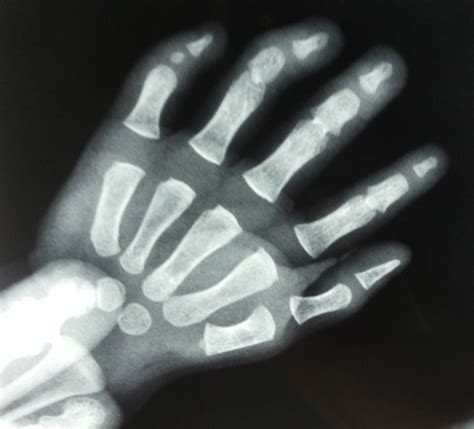 fusion  interphalangeal joints spot diagnosis pediatric oncall
