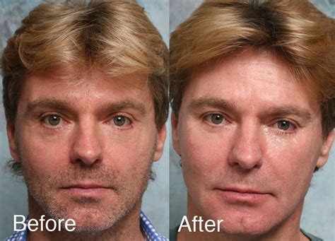 fixing botched  eyelids surgery repair  eyelid  wrong