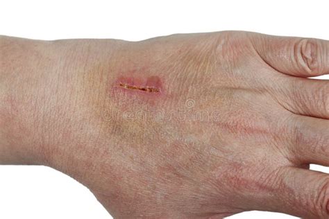 laceration stock photo image  laceration palm wound