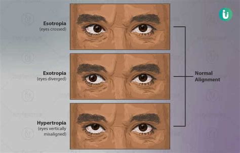 cross eyes symptoms  treatment medicine prevention diagnosis