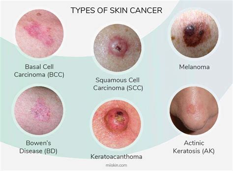 skin cancer pictures  common skin cancer types  images