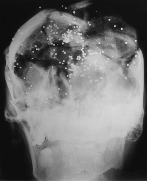 gunshot injuries    radiologist    radiographics