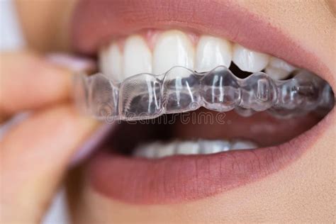 clear aligner dental night guard stock image image  teeth