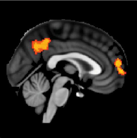white matter affects  people respond  brain stimulation therapy