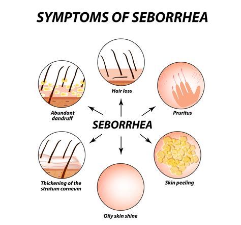 seborrheic dermatitis  hair loss symptoms  treatment