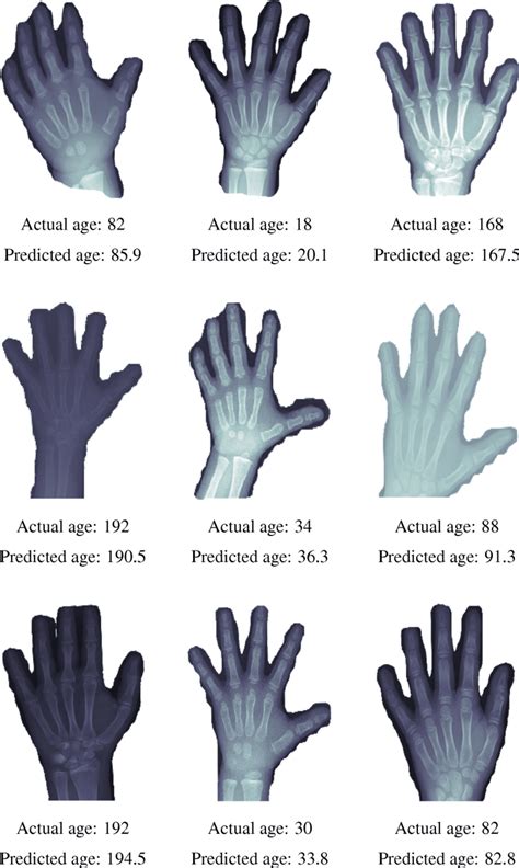 Actual And Predicted Bone Age Of Sample Images From The Test Rsna