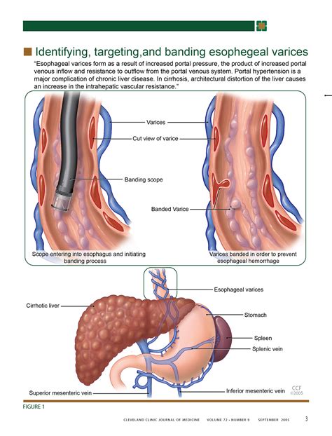 esophageal varices  behance