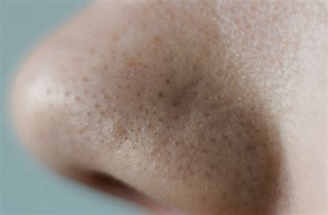 glycolic acid clogged pores guide  unclogging pores