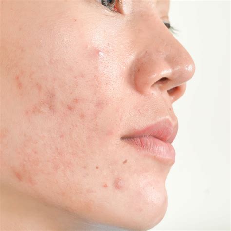 acne rosacea masterclass skin skills
