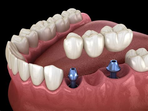 dental implants  avon ct newpoint family dental