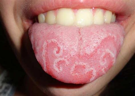 Peeling Tongue Causes How To Stop And Treatment