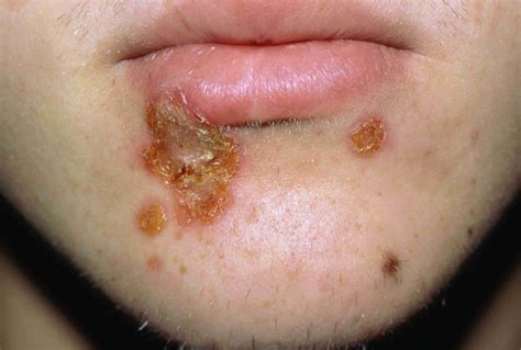 common skin rashes