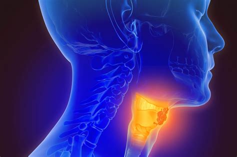 what does throat cancer feel like roswell park comprehensive cancer